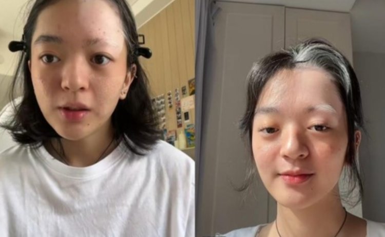 Wanita Ini Curhat Ngaku Idap Vitiligo Usai Bleaching Rambut